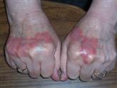 JoAnn hand psoriasis before